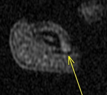 Figure 2 for case glomus tumor ( RID4513 )